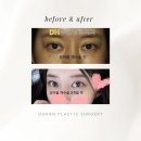 두한성형외과의원 | 풀린 쌍커풀, 완전절개 눈매교정, 인아웃라인 재수술, 쌍커풀 재수술, 두한성형외과 진솔리얼후기