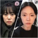 이지동안의원 | [이지동안] 땅콩형 얼굴 풀페이스 필러 후기! (옆광대, 팔자, 눈밑, 앞볼 +자갈턱 보톡스)