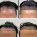 굿모나의원 | 두피타투 VS 모발이식 장단점과 차이점 비교