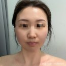 웰본페이스 | 강남윤곽관리 웰본 페이스 얼굴비대칭관리 받은 솔직후기