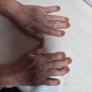 엔비테라피 | 경북 구미 석적 발 관리 맛집 뷰티엔비석적점, 두꺼운 무좀 발톱 파고드는 발톱 후기와 봉사이야기