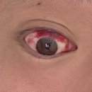 와이삼성이비인후과의원 | 목뒤 지방종 제거수술 후기 마산 삼성병원 주차 2인실 비용 보험서류