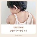 혈관종 치료 종결 후기(마포 공덕 에스앤, 잠실 리뉴미)
