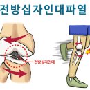 전방십자인대파열의 치료//전방십자인대 파열 이미지