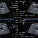 충수돌기 천공 복막염 이미지