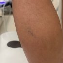 하지웰심장혈관흉부외과의원 | 다리부종과 피로감, 혹시 하지정맥류? 하지웰 흉부외과 방문후기