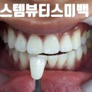 뷰티스 - 청주시 상당구 중고개로337번길 23 | 오스템 뷰티스 미백 후기, 시술 전 궁금한 점 정리