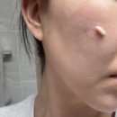 주기 | 리쥬란 힐러 주기 통증 부작용 후기