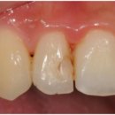 수화약국 | 앞니충치치료? '이것' 모르면 돈, 시간 2배로 깨져요 (후기, 레진)