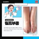 [남포동 피부과] 림프부종(Lymphedema)