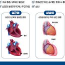 심장 통증 심낭염 심근염 및 이미지