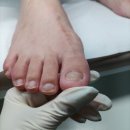 내성발톱 통증 드디어 해결 ! 내성발톱 치료 잘하는 구로역 서울늘봄메디칼의원