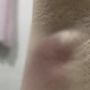 인공수정 준비 중 겨드랑이 피지낭종 제거술 후기 (항생제, 아스피린 영향 정리)