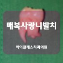 용원치과의원 | 뿌리가 심하게 휘어진 매복사랑니 발치 사례