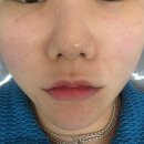 편평사마귀 당장 빼러가세요