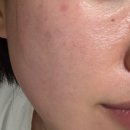 메이비의원 | [밴스의원 여의도] 라라필 + 나비존 스킨보톡스 + 승모근 보톡스 후기