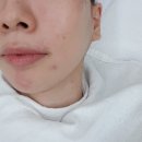 강남/역삼/선릉 에스테틱:: 피부관리 찐 만족한 &#39;엘스킨라운지&#39; (여드름 압출 전문)