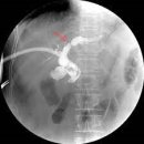 경피경간 담도 확장술[percutaneous transhepatic biliary dilatation]이란? 이미지