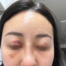 아진의전 | [기미치료2회차후기] 디톡스토닝레이저잘하는곳 강남역피부과 - 르샤인의원