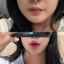 상무지구 피부과 광주입술필러 내돈내산 후기