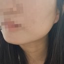 창원의원 | 바노바기의원 창원 볼뉴머 리프팅 300샷 내돈내산 후기