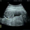 임신 16주3일 연제일신병원 2차 기형아 검사 결과 후기