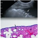 Lung lobe torsion in 15 dogs peripehral band sign 이미지