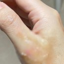 해든아침약국 | 수친자의 가내 수공 화상치료 후기 (메디폼 실버 / 미보 / 비아핀)