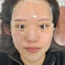 전주비타민약국 | 전주 완주 기미 주근깨 레이저토닝 | 점 잘 빼는 곳 | 점 제거 | 관리 방법 총정리 (내돈내산)