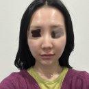 강외과의원 | 강남 추천 윤곽주사 사각턱보톡스로 얼굴라인 관리 내돈내산 일주일후기