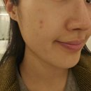 홍대입구역피부과 포텐자콜라스터 스킨부스터 후기