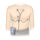 유방12통 | [뇌경색 일기 2편] 젊은 뇌경색, 심장검사와 24시간 홀터검사까지 받은 기록