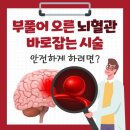 고령층 &#39;뇌동맥류&#39; 시술도 &#39;혈전&#39; 걱정 없다 이미지