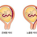 태반조기박리 vs 전치태반 증상 원인 치료 비교 이미지