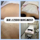 종로피부화장품 | 종로 등여드름압출 안아픈압출로 유명한 스킨피아 피부관리 후기
