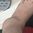 아작 | 발목 아작난 후기