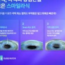 초고도 난시 원인 증상, 난시 교정 방법 부터 라섹까지 이미지