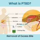 피부와 간을 통해 배액관(튜브)을 삽입하여 담즙을 몸 밖으로 빼내는 PTBD( 경피 경간 담도 배액술) ​ 이미지