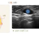 유방 결절 원인 5가지 및 가슴 멍울(몽우리) 낭종(물혹 혹) 섬유선종(양성종양) 유두종 지방종 이미지