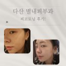다산햇빛에너지 | 다산 별내피부과 피코토닝 후기 및 가격 효과 등 리얼후기!