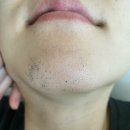 남자 레이저제모 젠틀맥스 프로 플러스 앞턱+인중 5회 20만원대 [시아의원] 철산 내돈내산 1회 후기