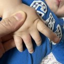 목감성모의원 | 아기 손이 문에 끼었어요 목감 정형외과 엑스레이 찍고옴