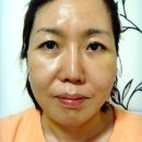 face lift 한지 2주됐어요. 이미지