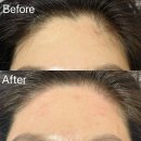 핑크헤어라인 | 의정부 망월사역 랑쥬뷰티 랑쥬왁싱&amp;속눈썹 이마 헤어라인 왁싱 내돈내산 후기