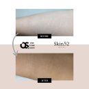 차스킨일산 | 일산 스킨52 손목 흉터 1회차 시술 후기