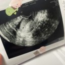 토토의 하루) 7주 계류우산 증상후 소파술 후기