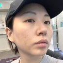 청담 레옹 | 리투오 스킨부스터 더마샤인 후기, 결절, 효과까지 자세하게!