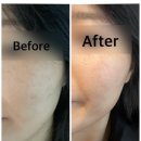 서면아이온시티빌딩 | 부산 서면 바노바기 첫 피코토닝 찐 후기