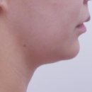 청담청초성형외과의원 네이버블로그