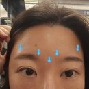 7466 | 워킹맘 일상 : 보톡스편 | 내돈내산 블리비 구미점 미간 보톡스 후기